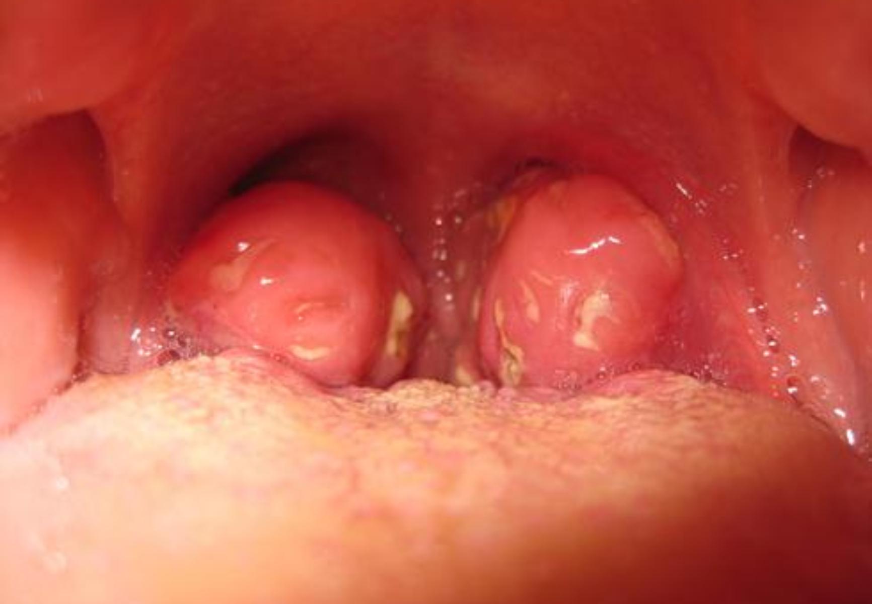 Αμυγδαλές και κρεατάκια στα παιδιά: Τα προβλήματα που δημιουργούν και πότε πρέπει να αφαιρεθούν