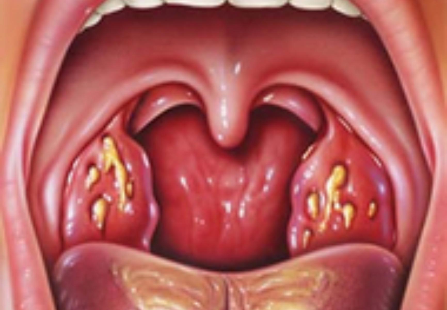 Αμυγδαλές και κρεατάκια στα παιδιά: Τα προβλήματα που δημιουργούν και πότε πρέπει να αφαιρεθούν