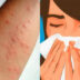Αλλεργίες την Άνοιξη: Γιατί φέτος τα συμπτώματα είναι πιο έντονα από κάθε άλλη χρονιά;