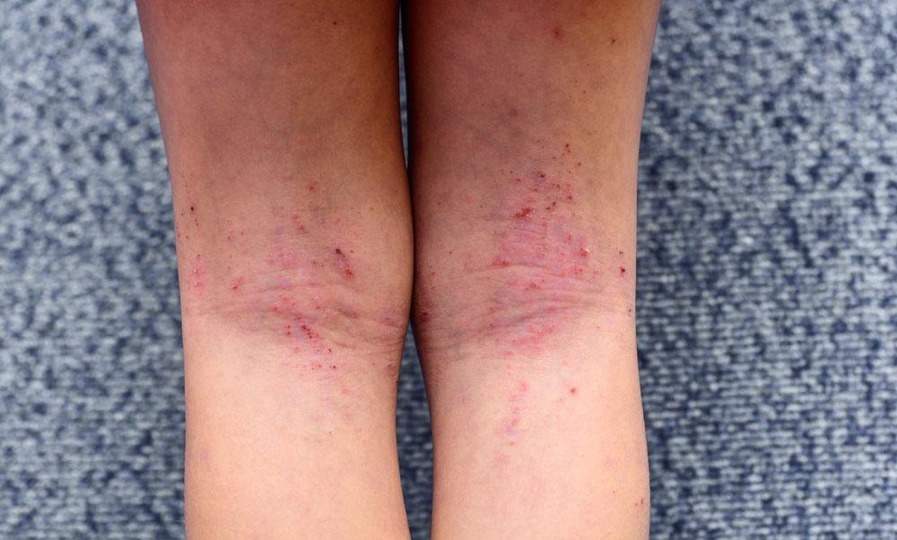 Αποτρίχωση με λέιζερ-κίνδυνοι-για-την-υγεία- Αποτρίχωση με λέιζερ-κίνδυνοι-για-την-υγεία-