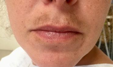 Αποτρίχωση με λέιζερ-κίνδυνοι-για-την-υγεία- Αποτρίχωση με λέιζερ-κίνδυνοι-για-την-υγεία-