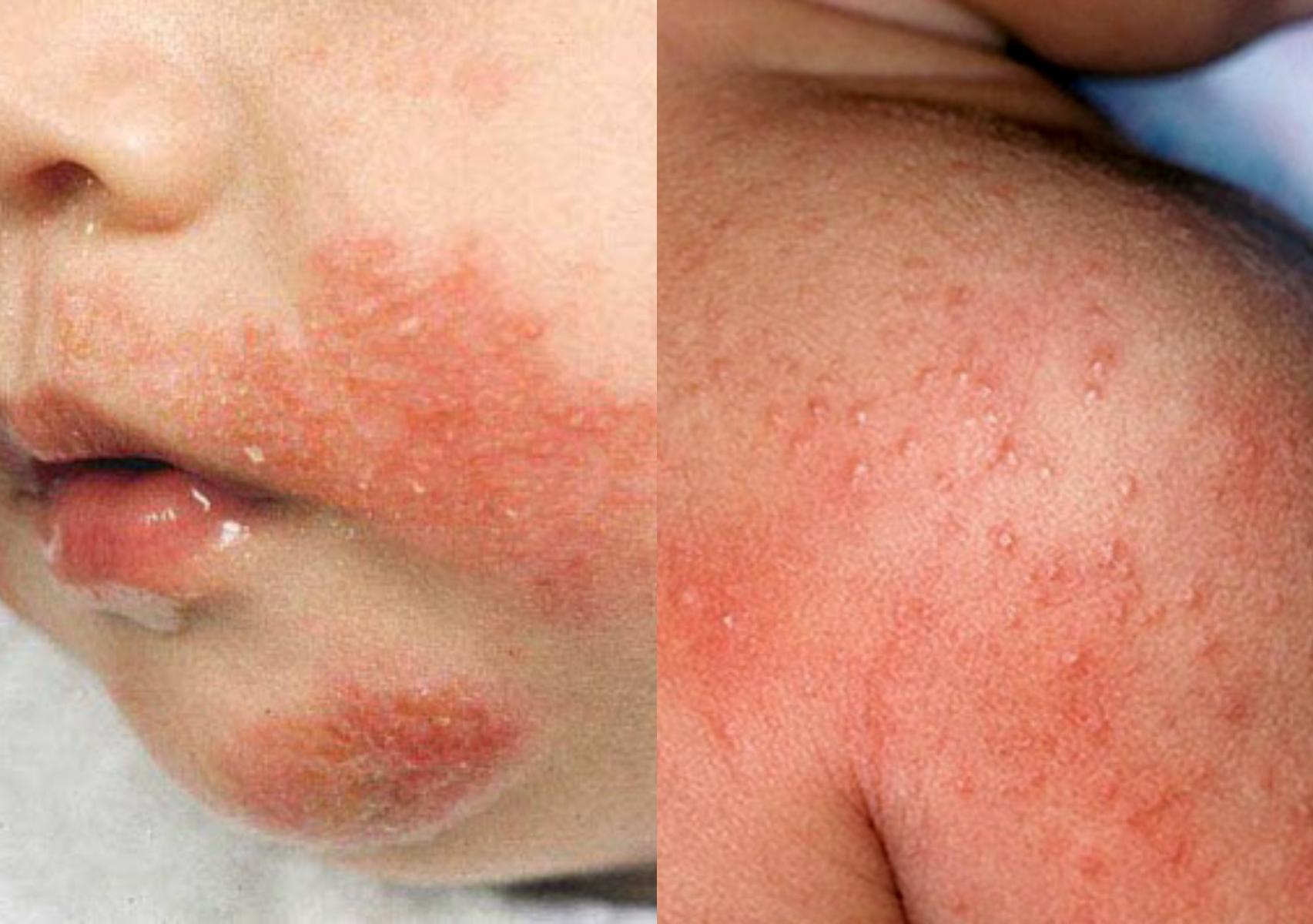 Ατοπική δερματίτιδα σε βρέφη και παιδιά: Τι είναι ποια τα συμπτώματα και πως να την αντιμετωπίσετε