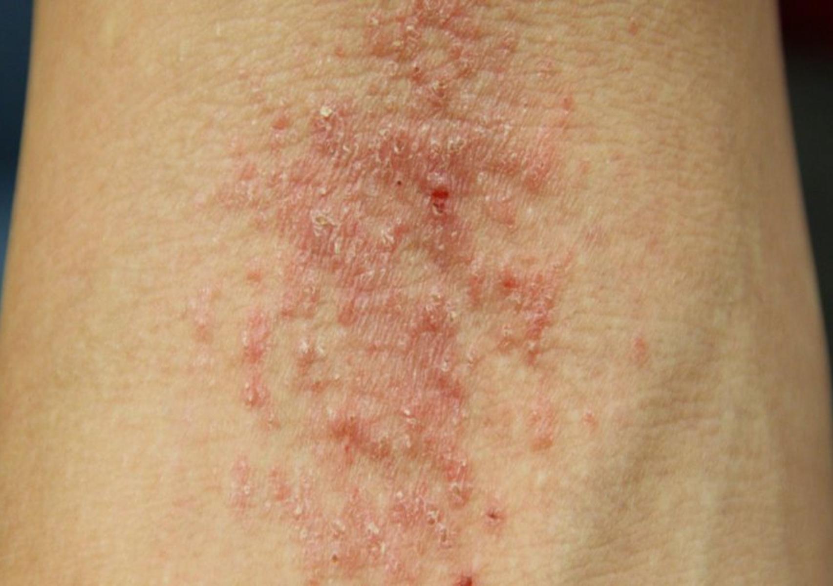 Ατοπική δερματίτιδα σε βρέφη και παιδιά: Τι είναι ποια τα συμπτώματα και πως να την αντιμετωπίσετε