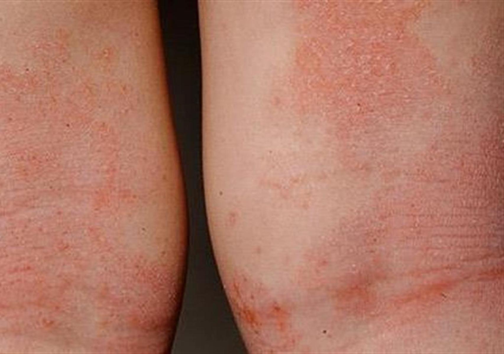 Ατοπική δερματίτιδα σε βρέφη και παιδιά: Τι είναι ποια τα συμπτώματα και πως να την αντιμετωπίσετε