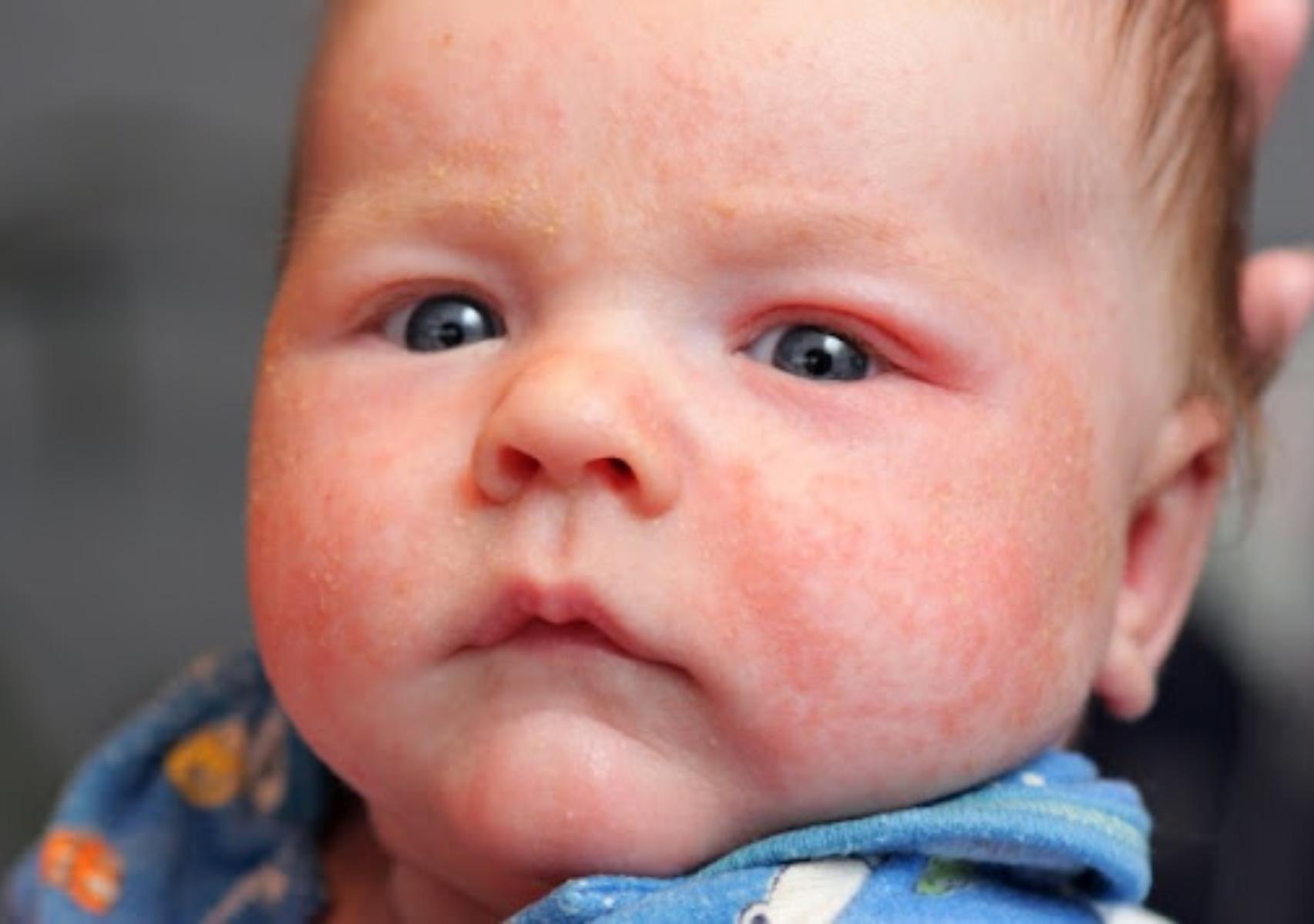 Ατοπική δερματίτιδα σε βρέφη και παιδιά: Τι είναι ποια τα συμπτώματα και πως να την αντιμετωπίσετε