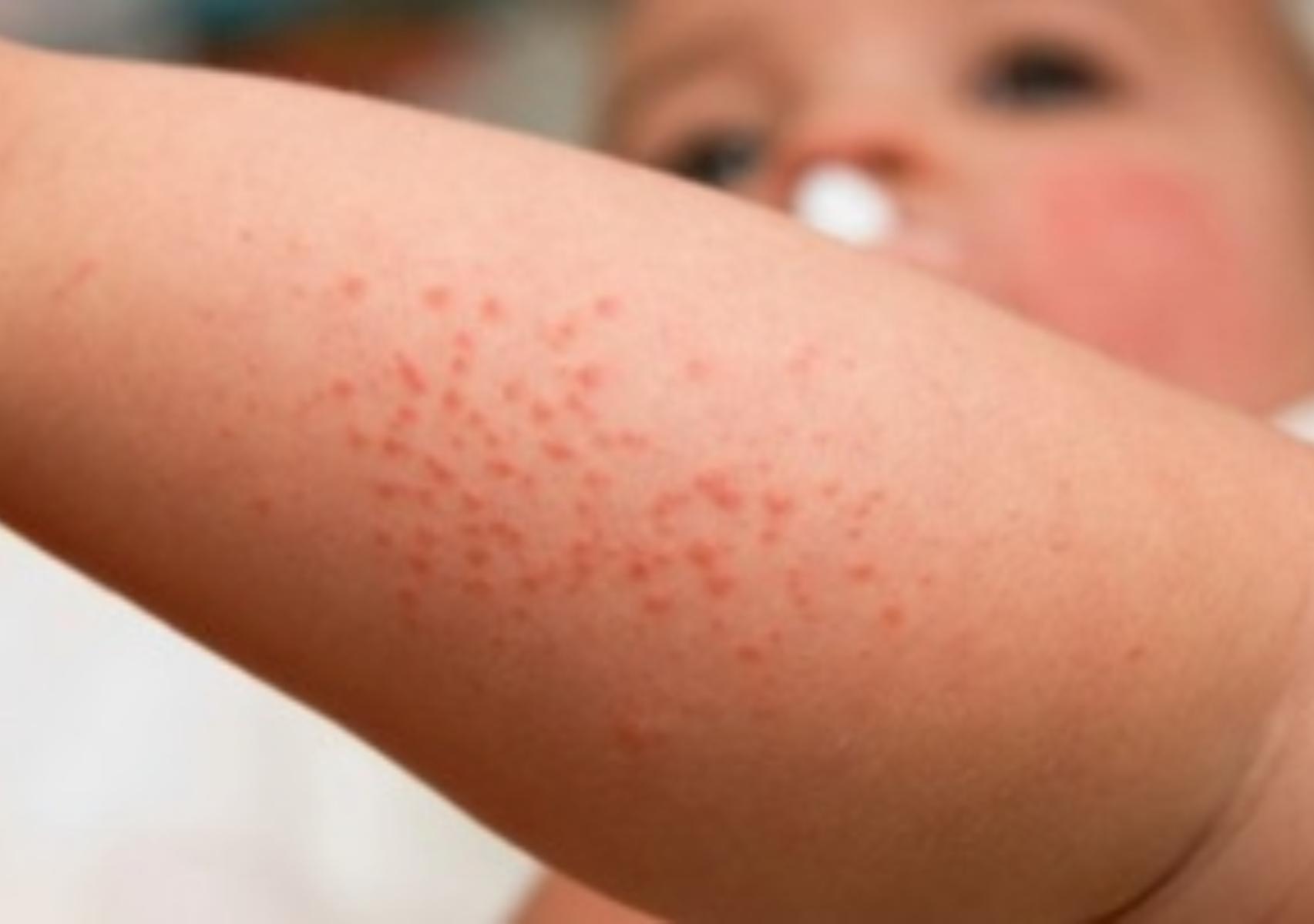 Ατοπική δερματίτιδα σε βρέφη και παιδιά: Τι είναι ποια τα συμπτώματα και πως να την αντιμετωπίσετε