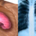 Ατελεκτασία πνεύμονα: Τι είναι ποια τα συμπτώματα και πως αντιμετωπίζεται