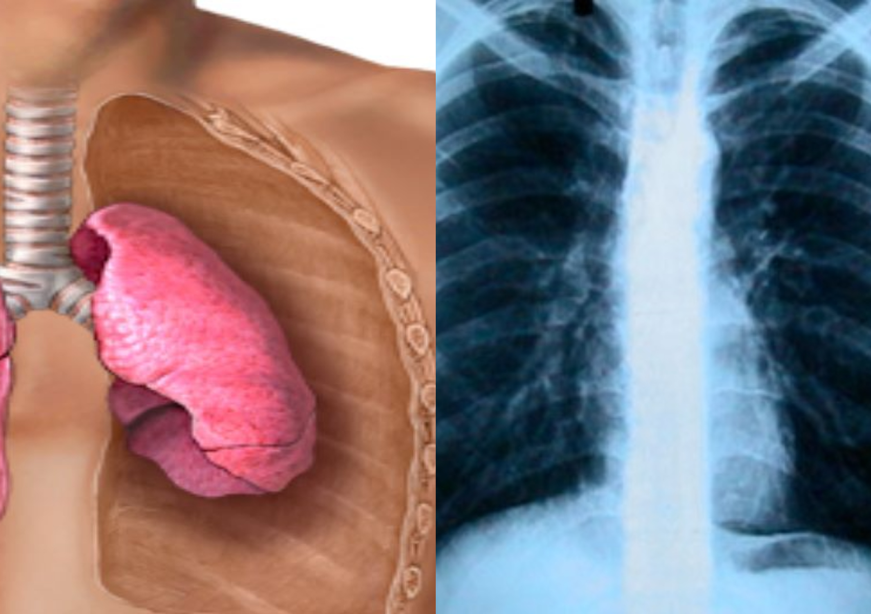 Ατελεκτασία πνεύμονα: Τι είναι ποια τα συμπτώματα και πως αντιμετωπίζεται