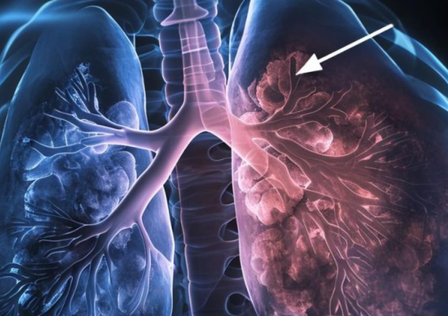 Ατελεκτασία πνεύμονα: Τι είναι ποια τα συμπτώματα και πως αντιμετωπίζεται