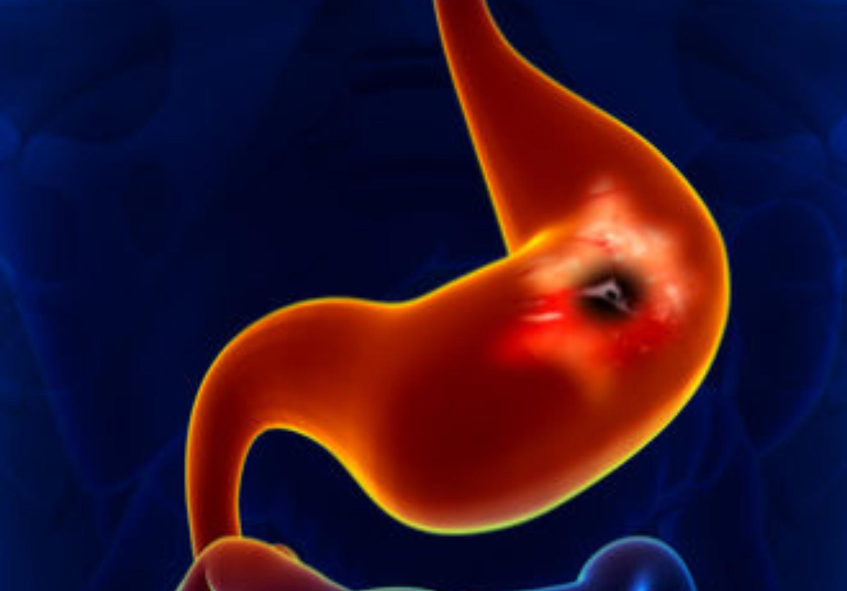 Πεπτικό έλκος: Τι είναι ποια τα συμπτώματα και πως αντιμετωπίζεται