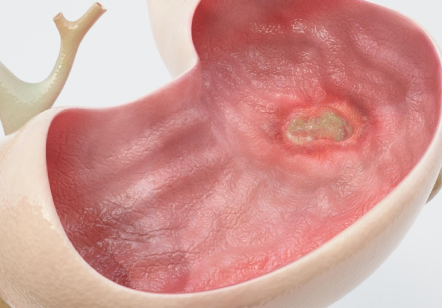 Πεπτικό έλκος: Τι είναι ποια τα συμπτώματα και πως αντιμετωπίζεται