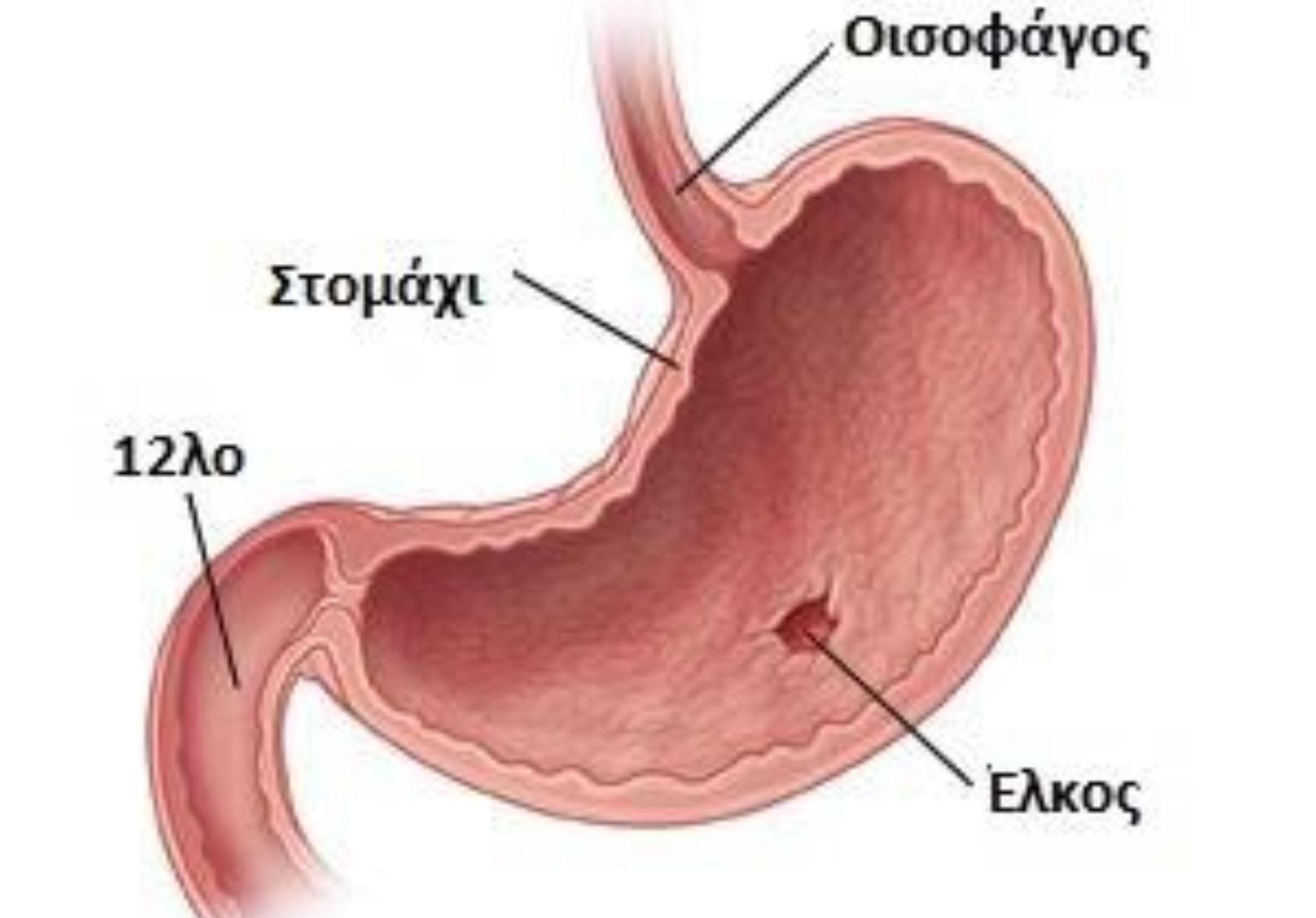 Πεπτικό έλκος: Τι είναι ποια τα συμπτώματα και πως αντιμετωπίζεται