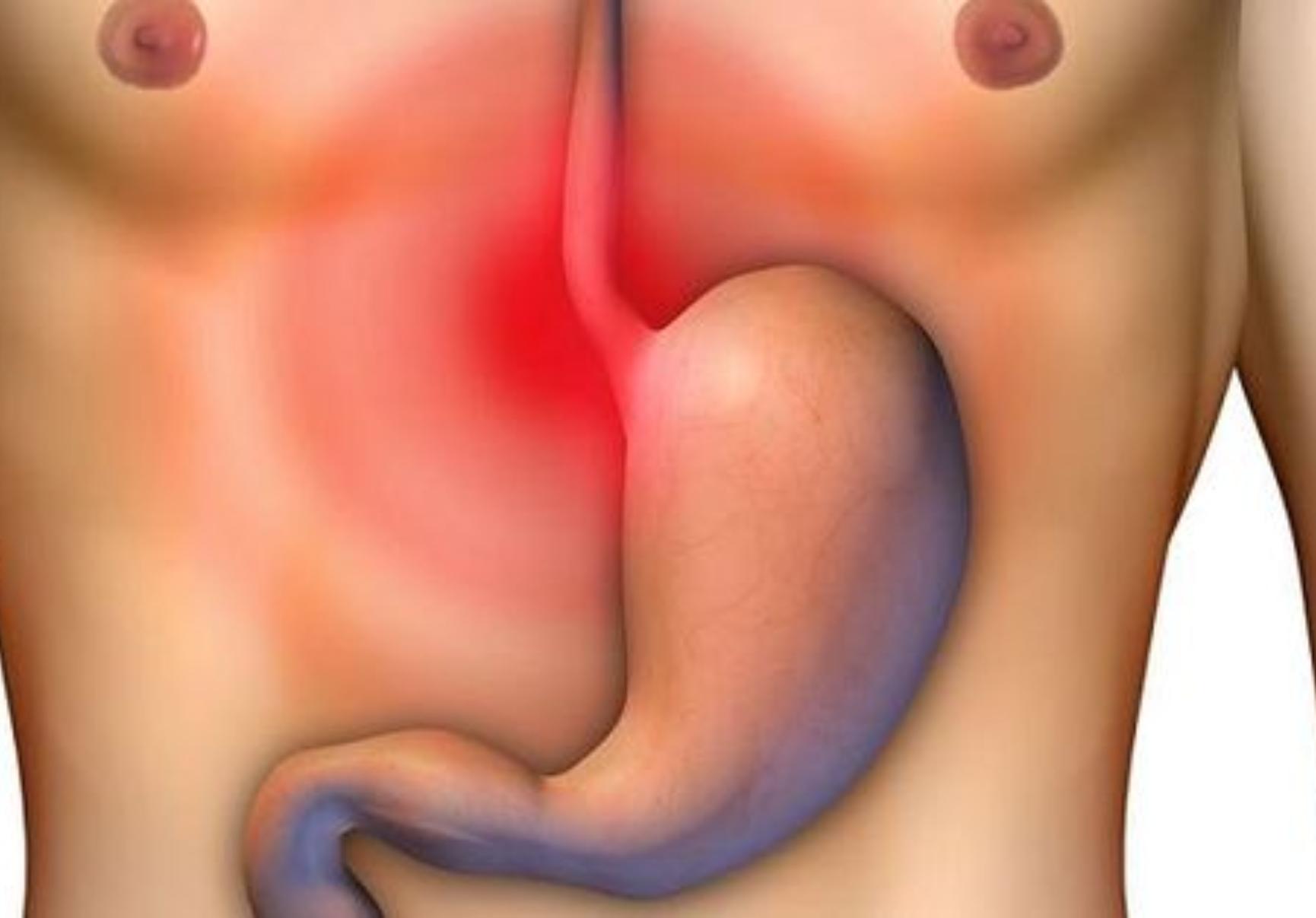 Πεπτικό έλκος: Τι είναι ποια τα συμπτώματα και πως αντιμετωπίζεται