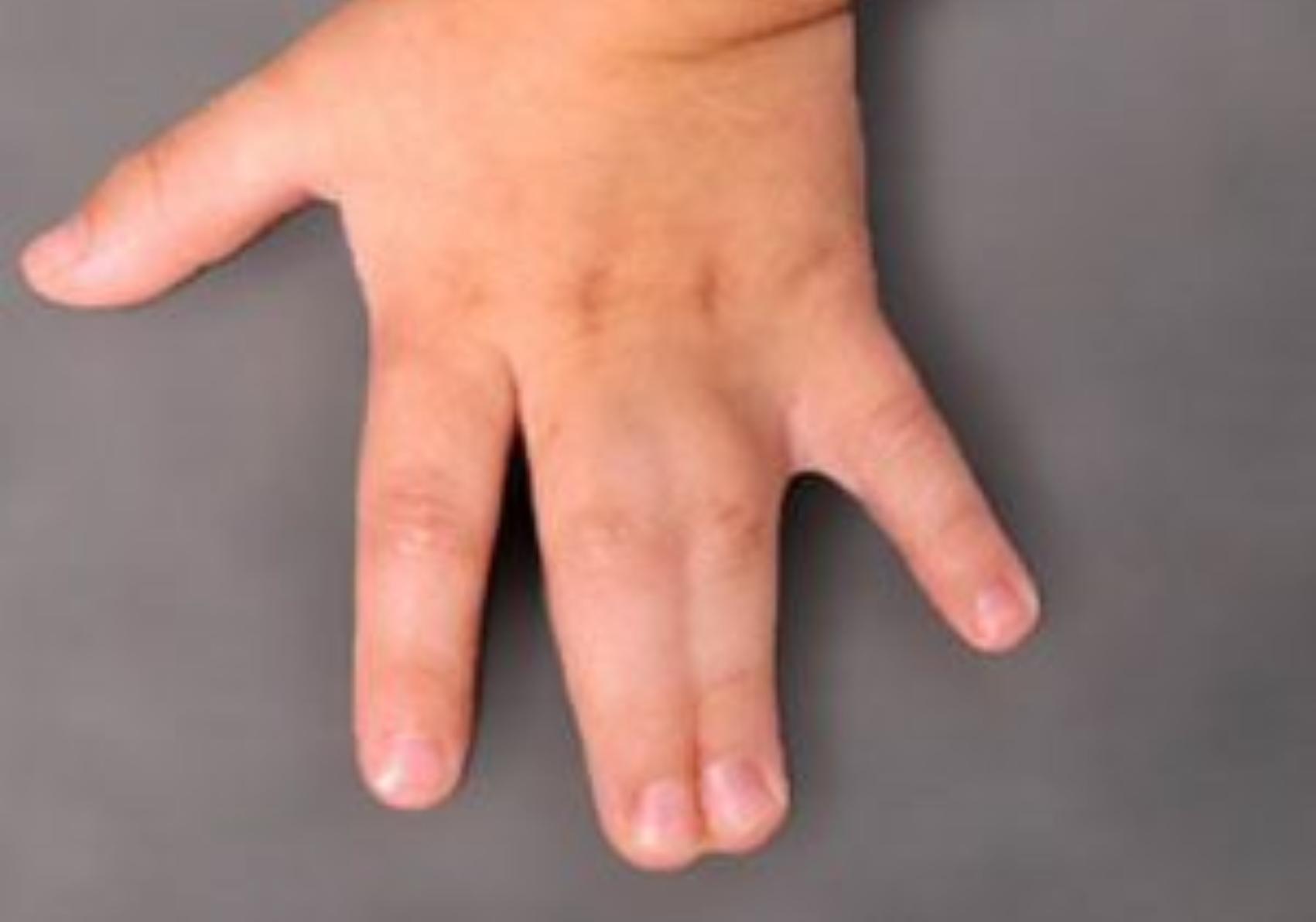 Συνδακτυλία: Τι είναι και πως αντιμετωπίζεται