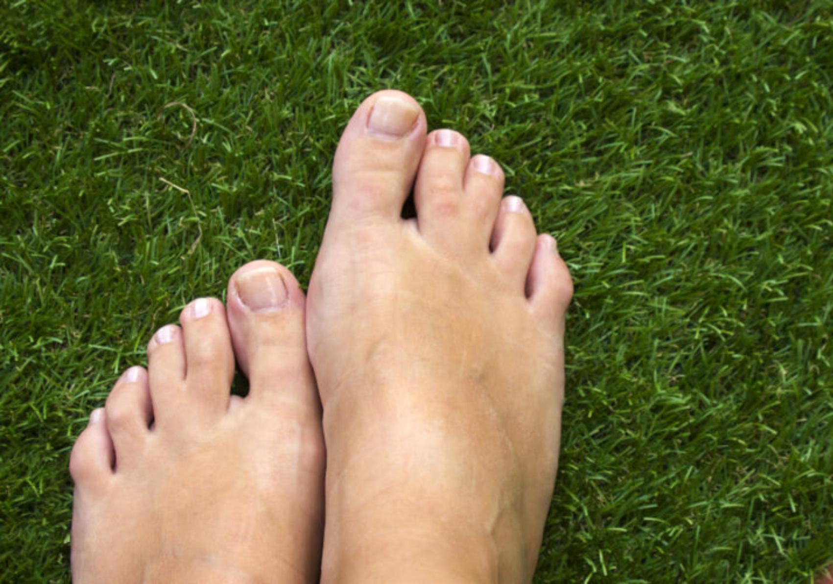 Συνδακτυλία: Τι είναι και πως αντιμετωπίζεται