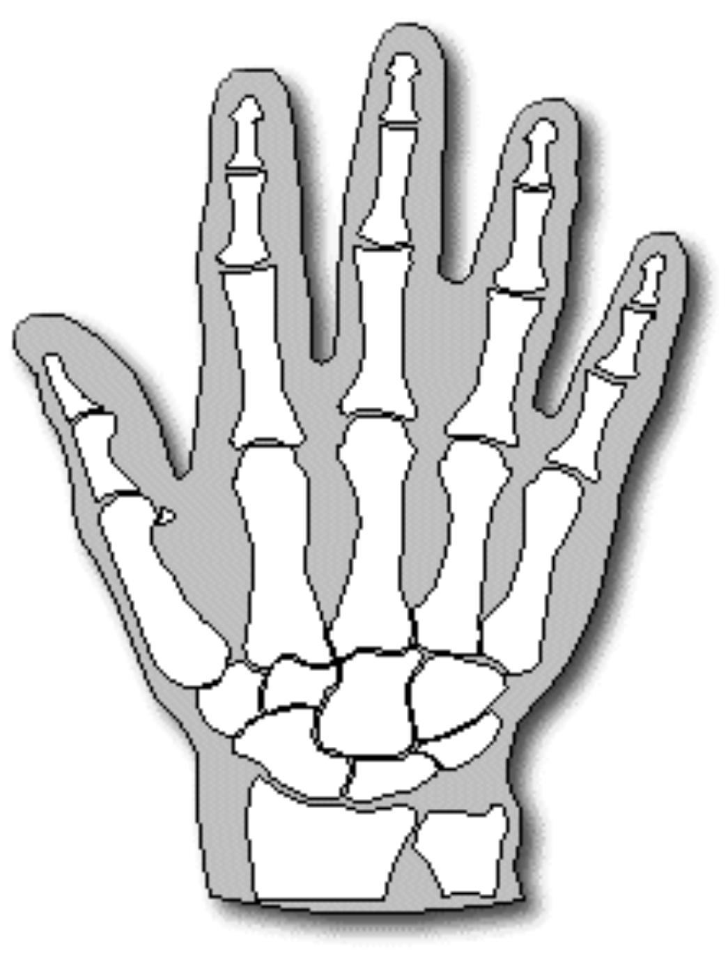 Συνδακτυλία: Τι είναι και πως αντιμετωπίζεται