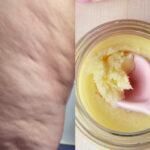 Κυτταρίτιδα: Η Diy μάσκα που υπόσχεται να απαλλαγείτε από την όψη φλοιού πορτοκαλιού