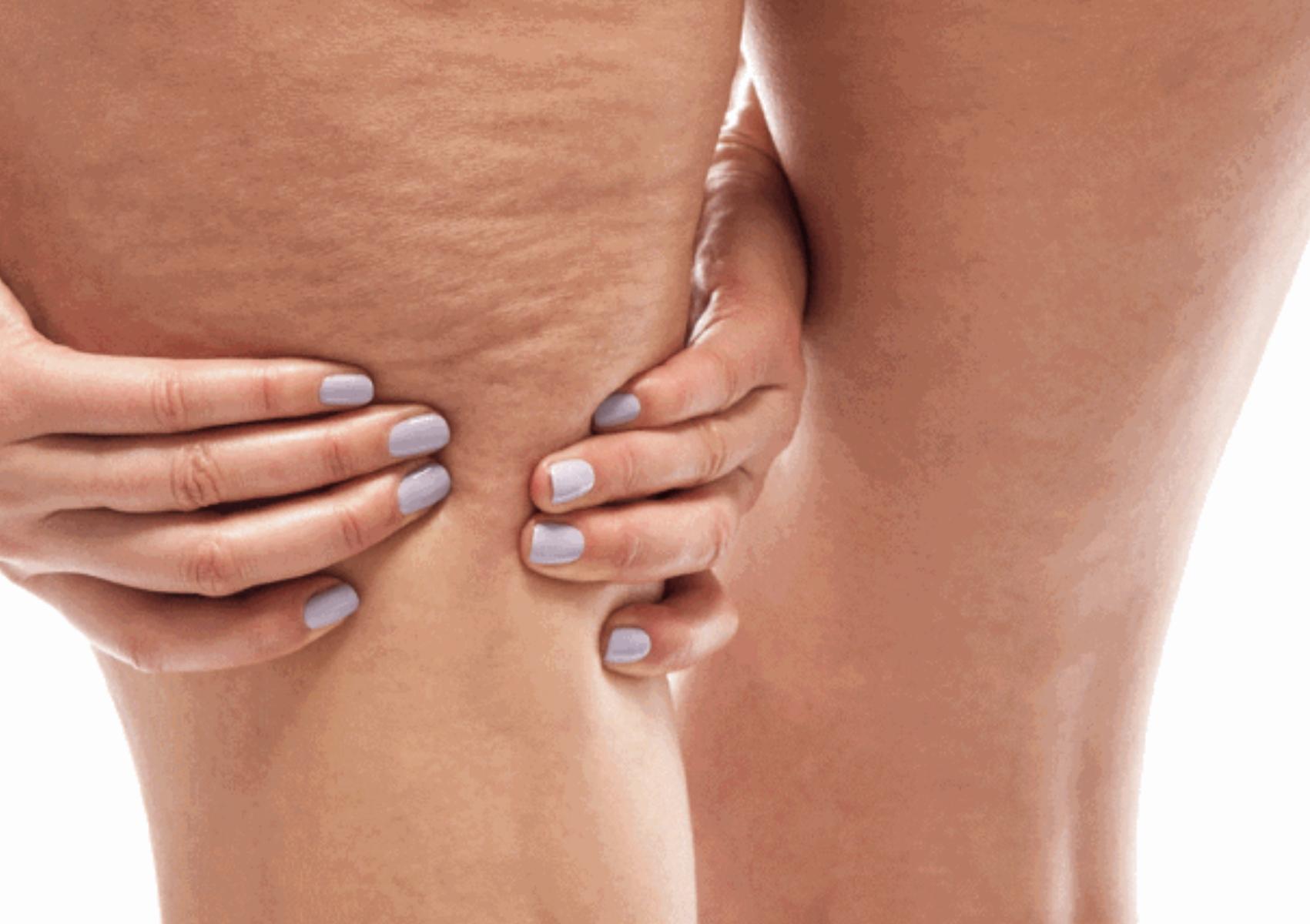 Κυτταρίτιδα: Η Diy μάσκα που υπόσχεται να απαλλαγείτε από την όψη φλοιού πορτοκαλιού