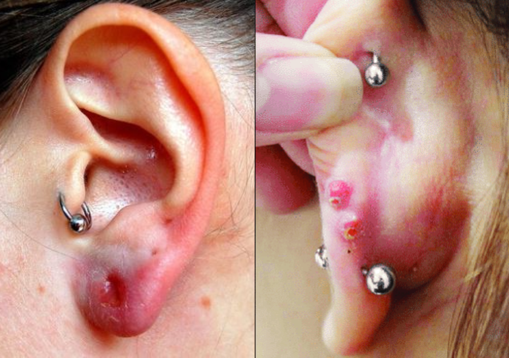 Μόλυνση από σκουλαρίκι: Τα συμπτώματα και πως να την αντιμετωπίσετε 