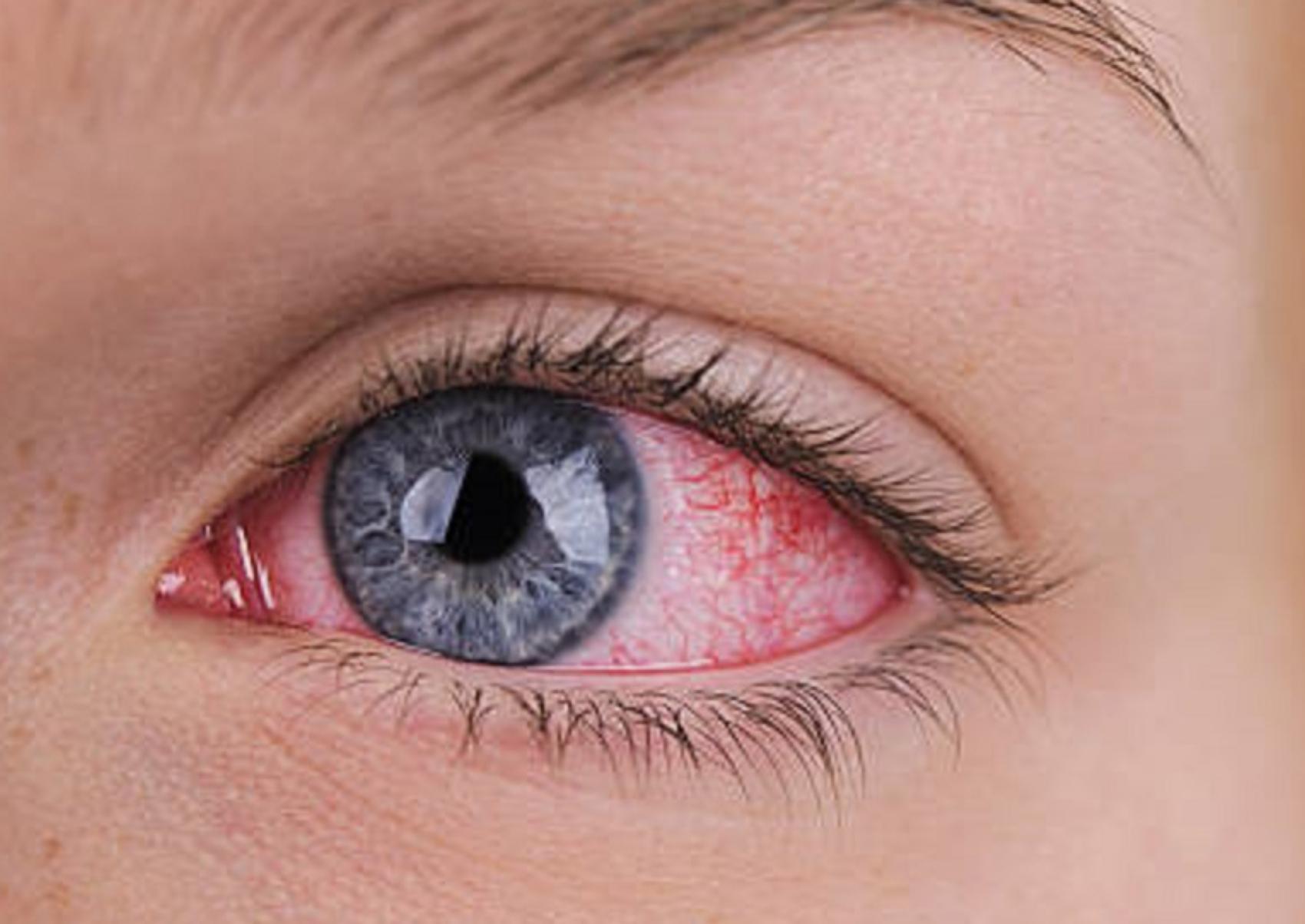 Επιπεφυκίτιδα στα παιδιά και τα βρέφη: Ποια τα αίτια τα συμπτώματα και ποια η θεραπεία