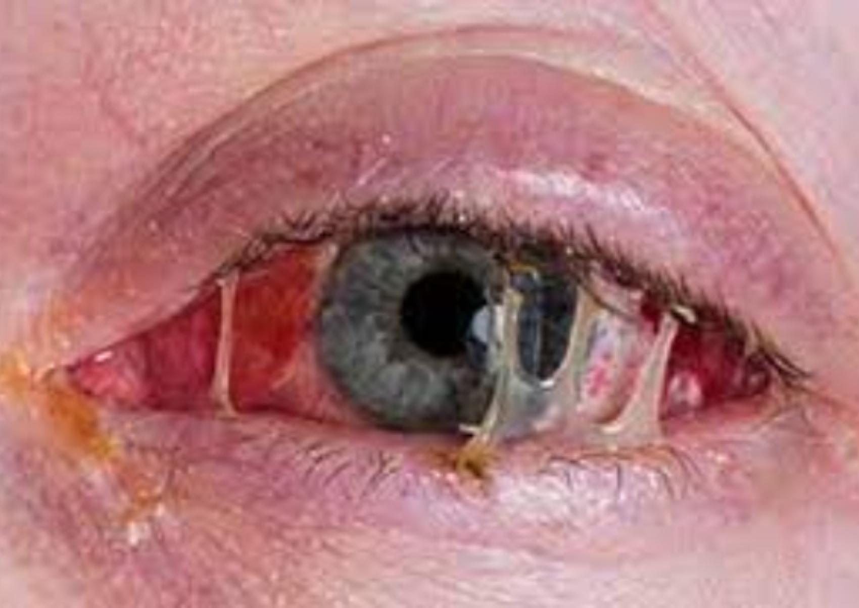 Επιπεφυκίτιδα στα παιδιά και τα βρέφη: Ποια τα αίτια τα συμπτώματα και ποια η θεραπεία