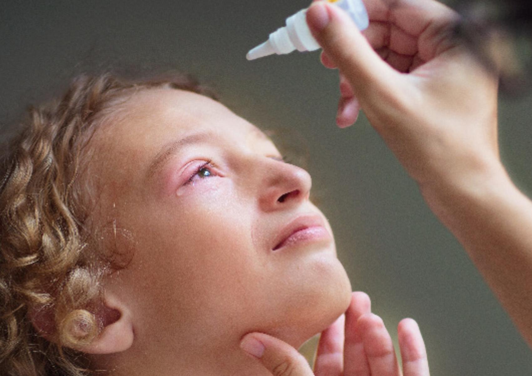 Επιπεφυκίτιδα στα παιδιά και τα βρέφη: Ποια τα αίτια τα συμπτώματα και ποια η θεραπεία