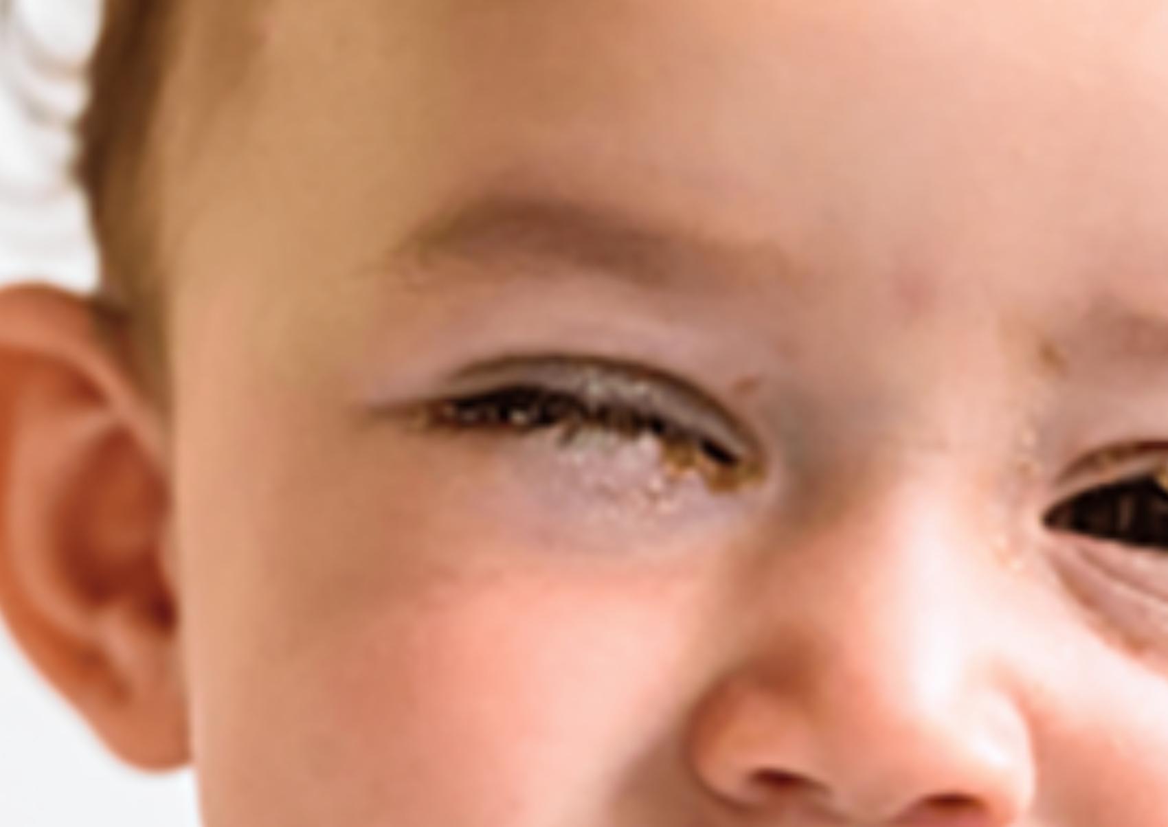 Επιπεφυκίτιδα στα παιδιά και τα βρέφη: Ποια τα αίτια τα συμπτώματα και ποια η θεραπεία