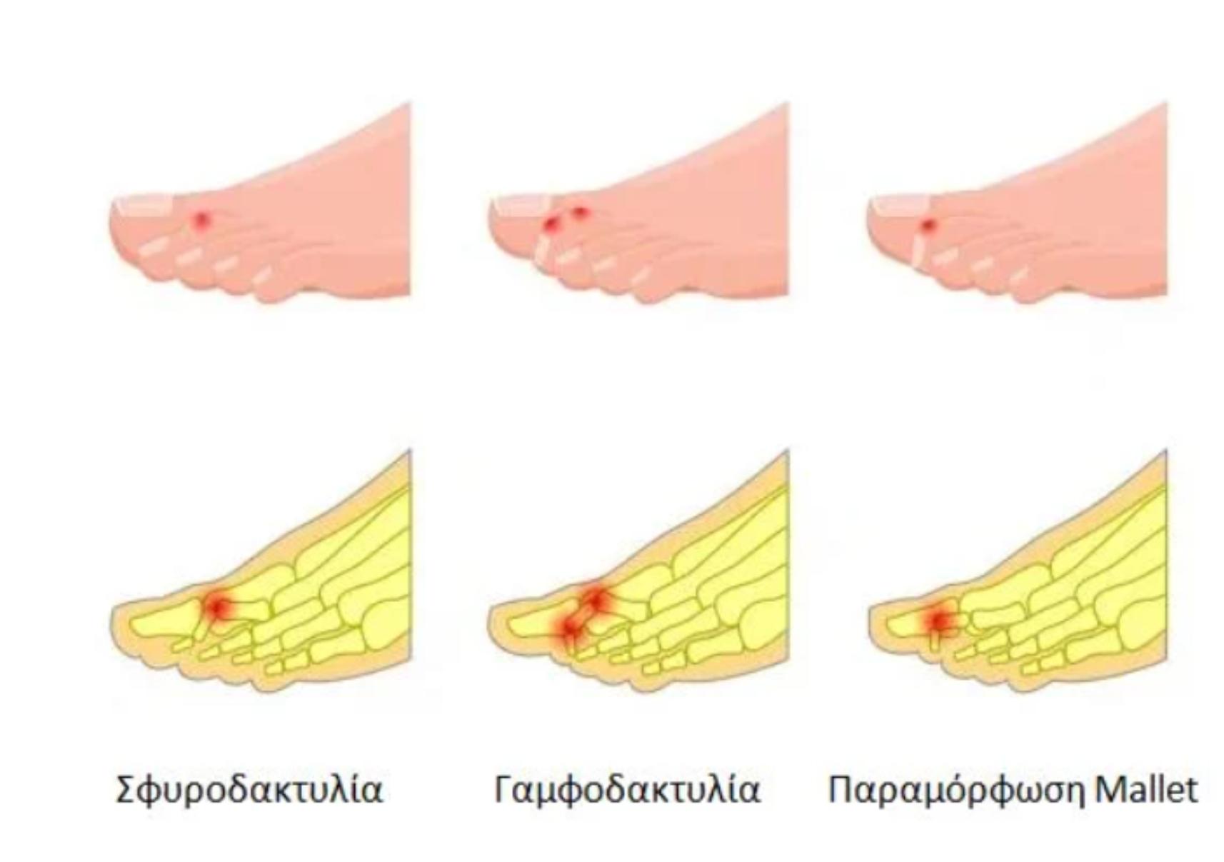 Σφυροδακτυλία: Τι είναι ποια τα αίτια και ποια η θεραπεία