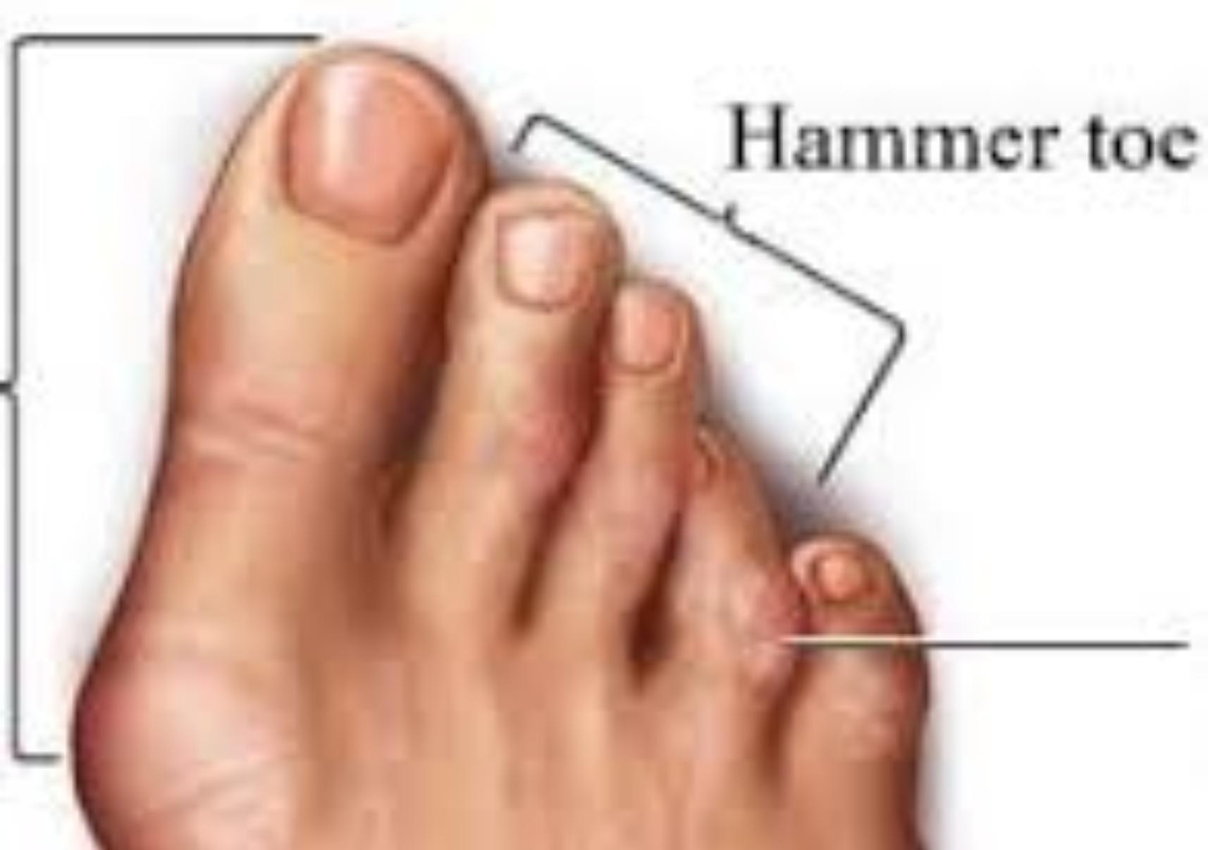 Σφυροδακτυλία: Τι είναι ποια τα αίτια και ποια η θεραπεία