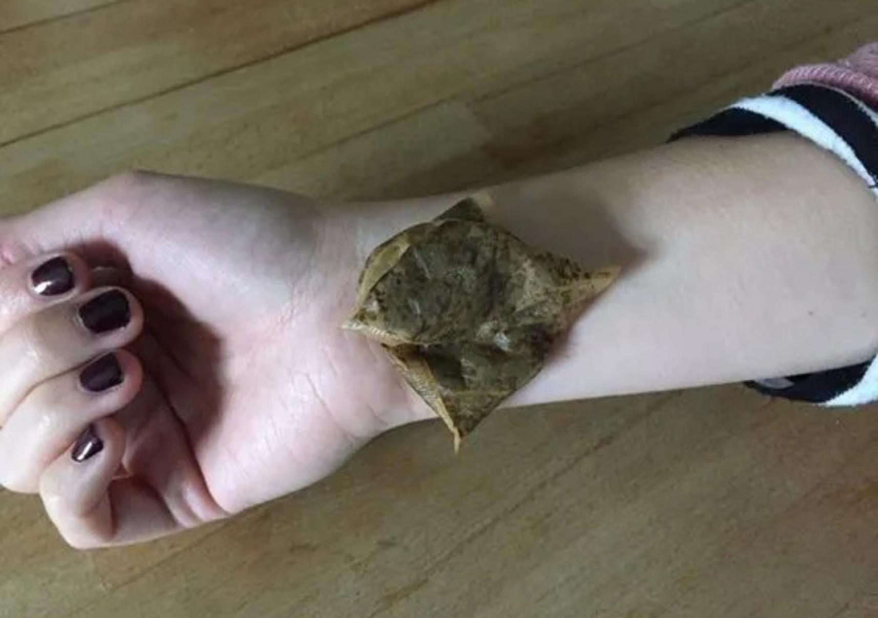 Τσίμπημα σφήκας: 10 Σπιτικοί Τρόποι για να το αντιμετωπίσετε και να ανακουφίσετε τον πόνο