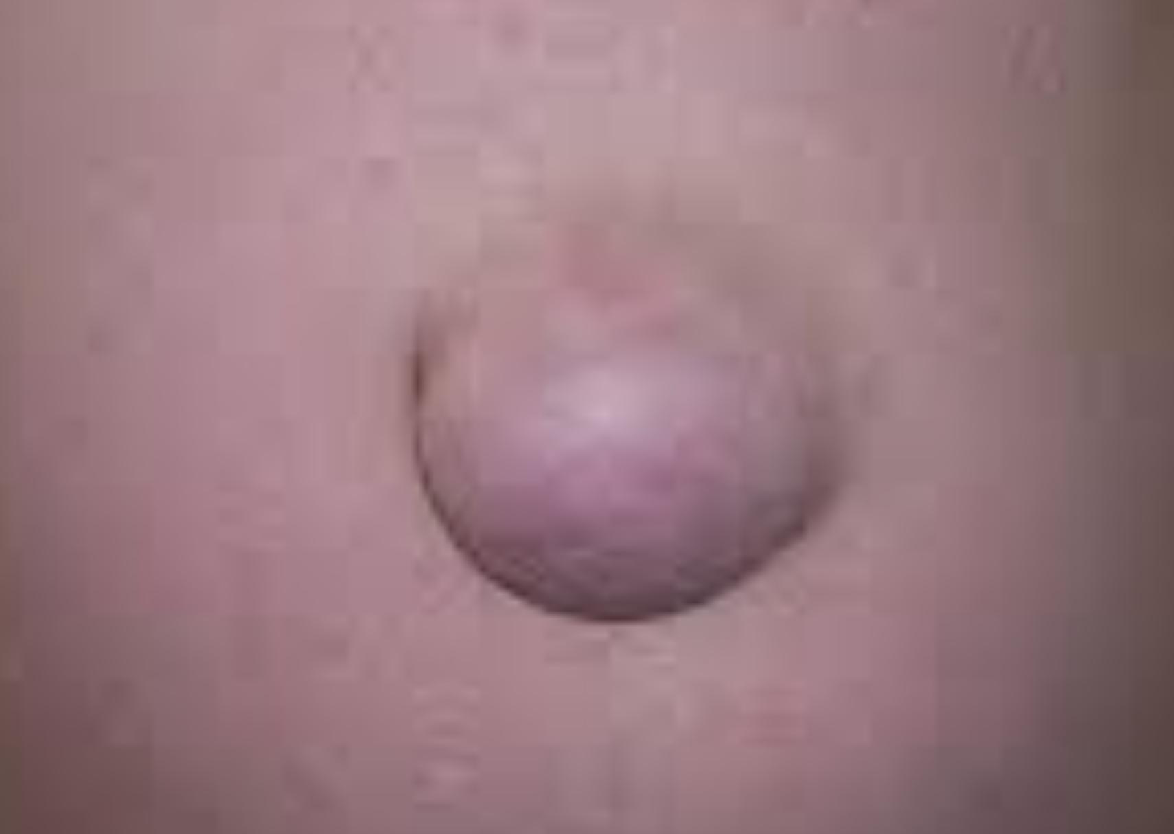 Ομφαλοκήλη: Τι είναι ποια τα αίτια και ποια η θεραπεία