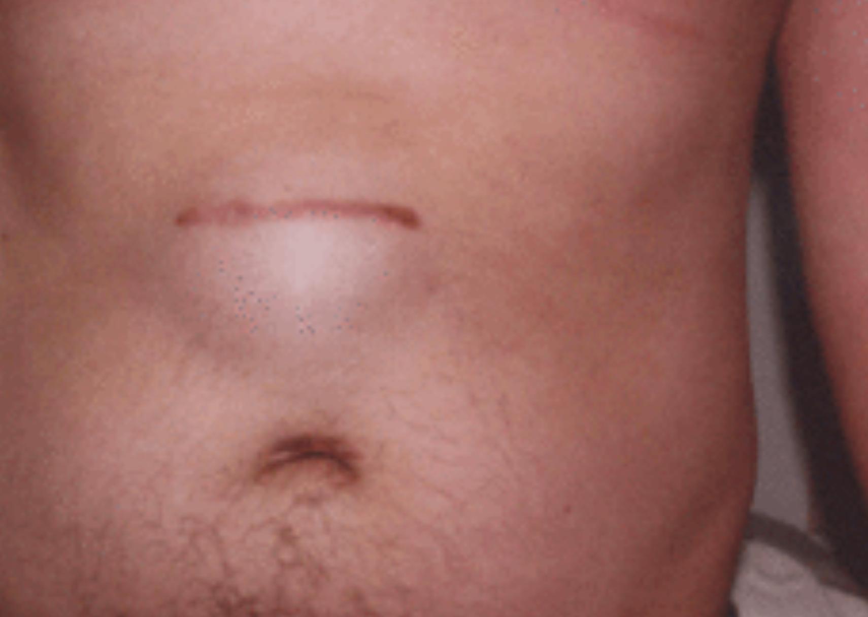 Ομφαλοκήλη: Τι είναι ποια τα αίτια και ποια η θεραπεία