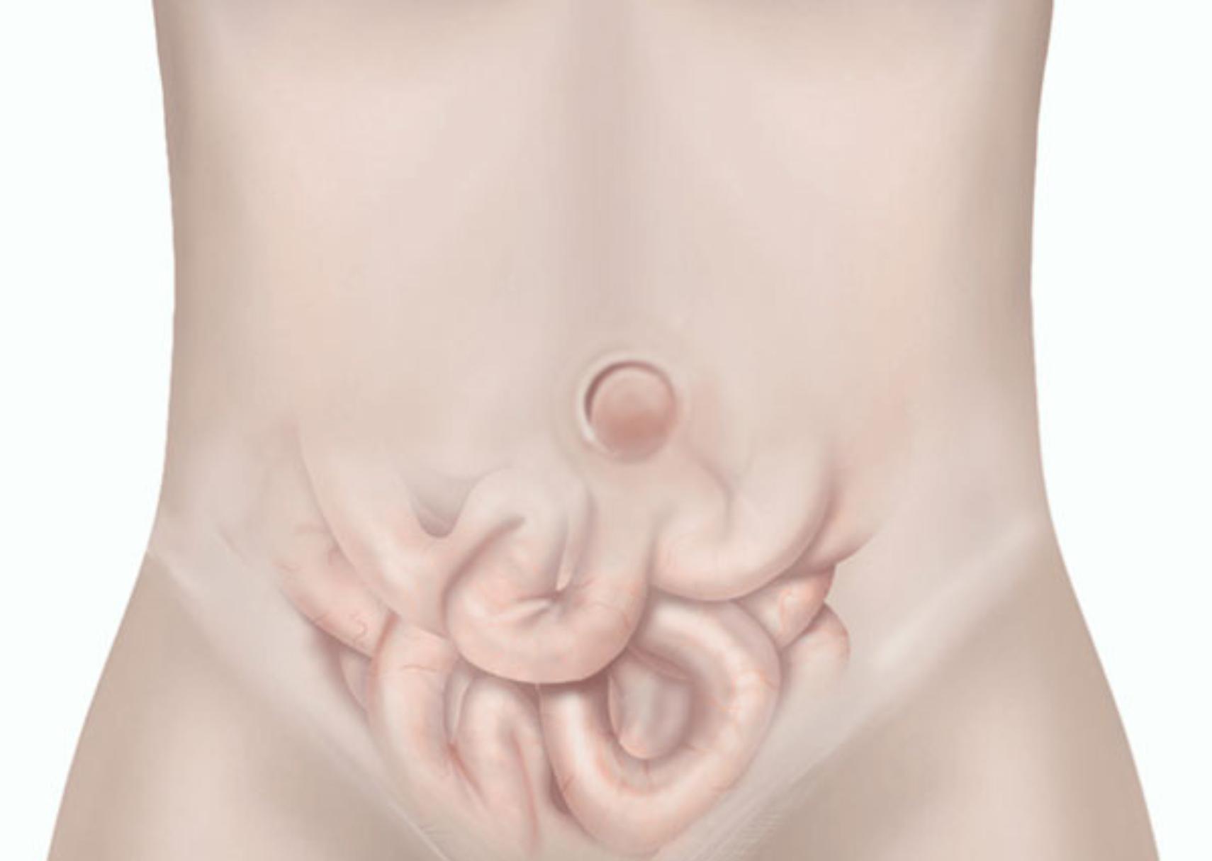 Ομφαλοκήλη: Τι είναι ποια τα αίτια και ποια η θεραπεία