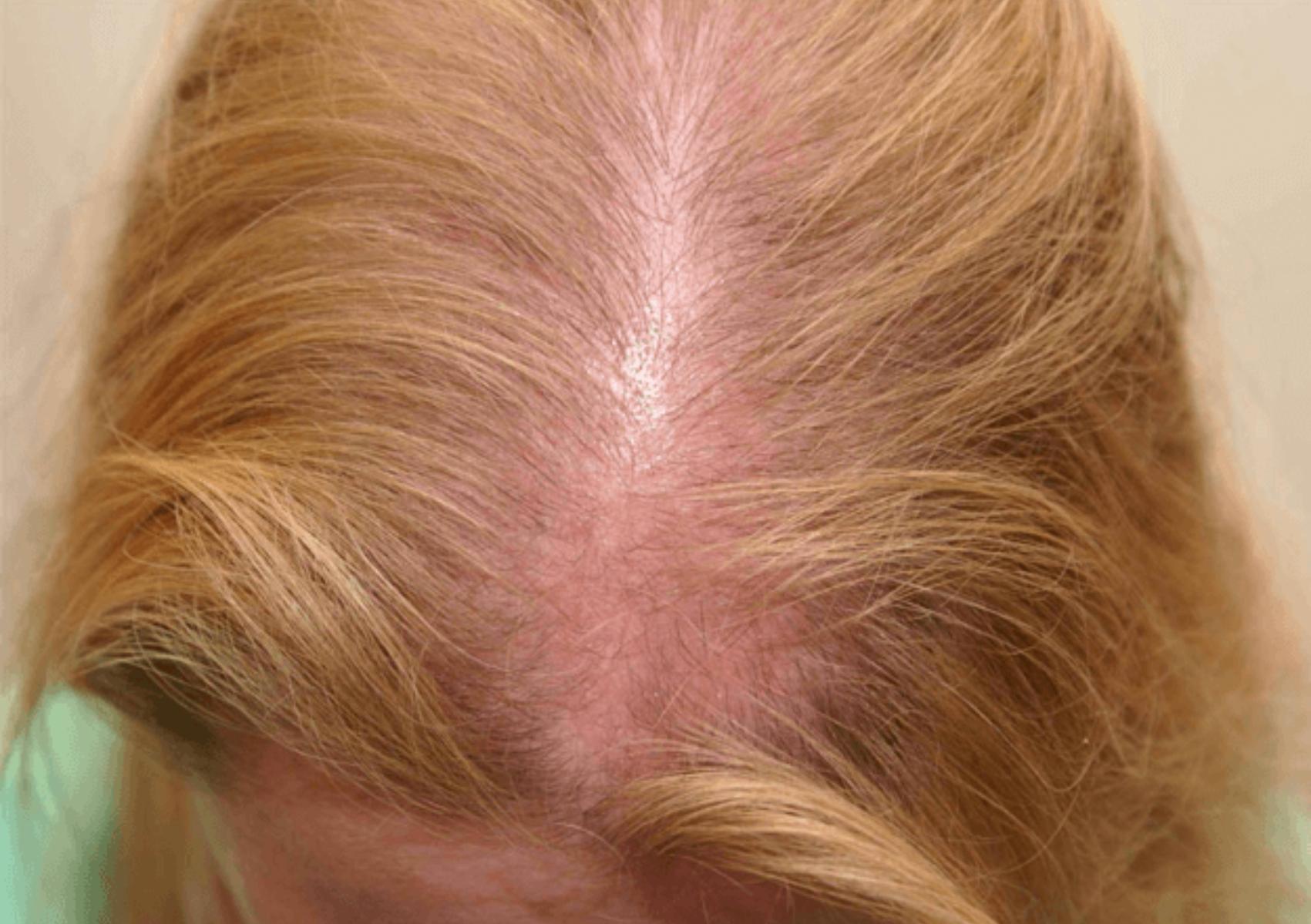 Τριχόπτωση- Τριχόπτωση-