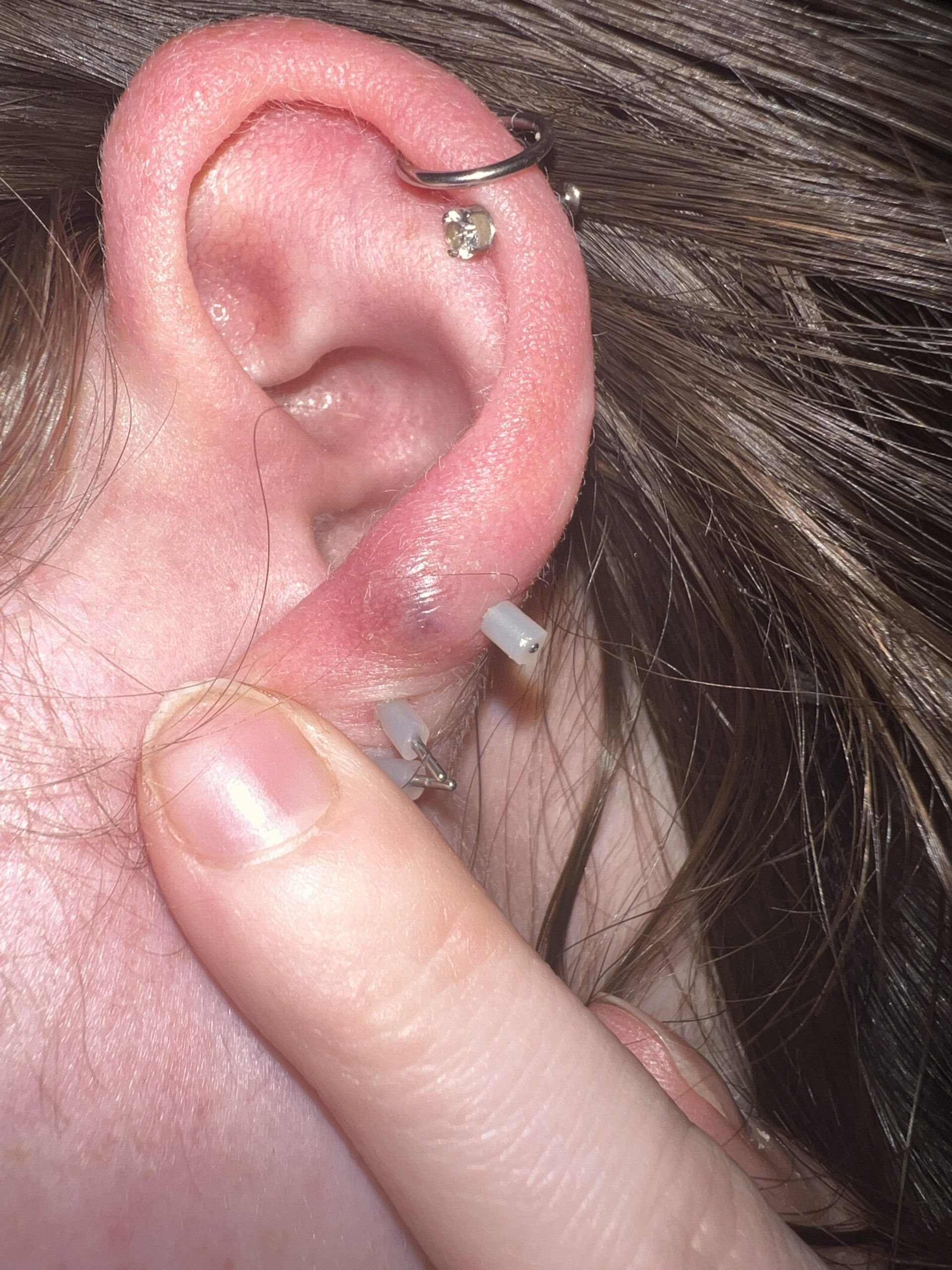 Μόλυνση από σκουλαρίκι: Τα συμπτώματα και πως να την αντιμετωπίσετε