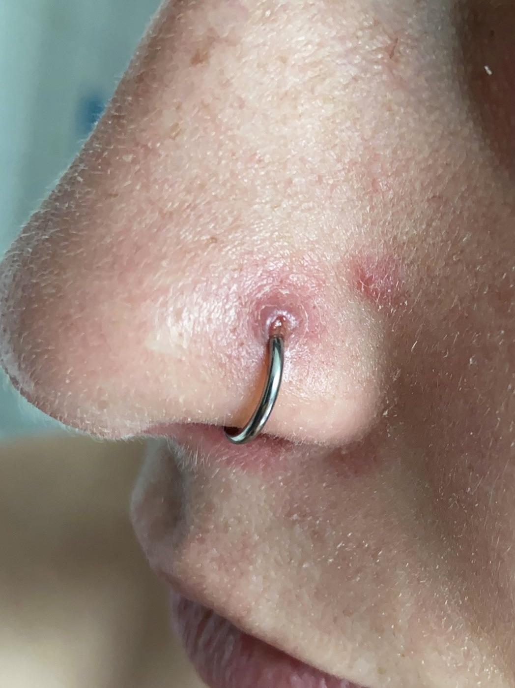 Μόλυνση από σκουλαρίκι: Τα συμπτώματα και πως να την αντιμετωπίσετε