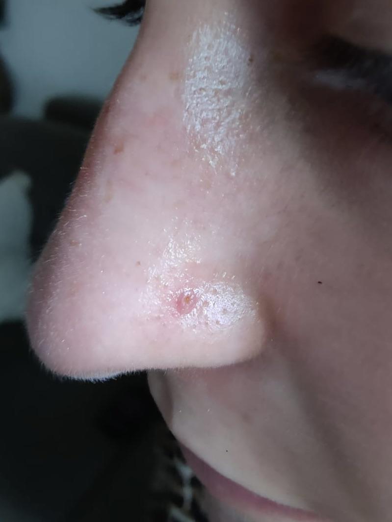 Μόλυνση από σκουλαρίκι: Τα συμπτώματα και πως να την αντιμετωπίσετε