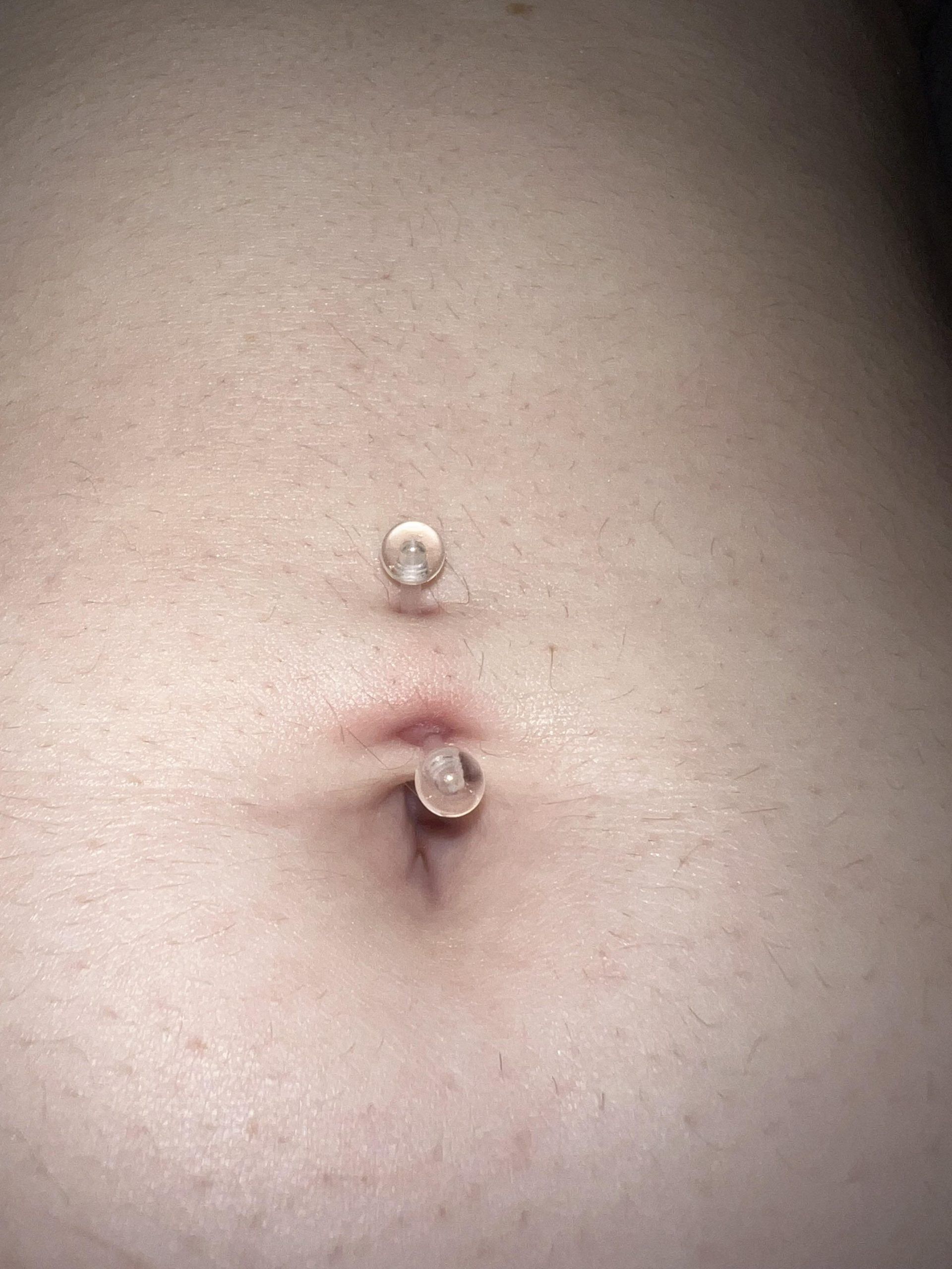 Μόλυνση από σκουλαρίκι: Τα συμπτώματα και πως να την αντιμετωπίσετε