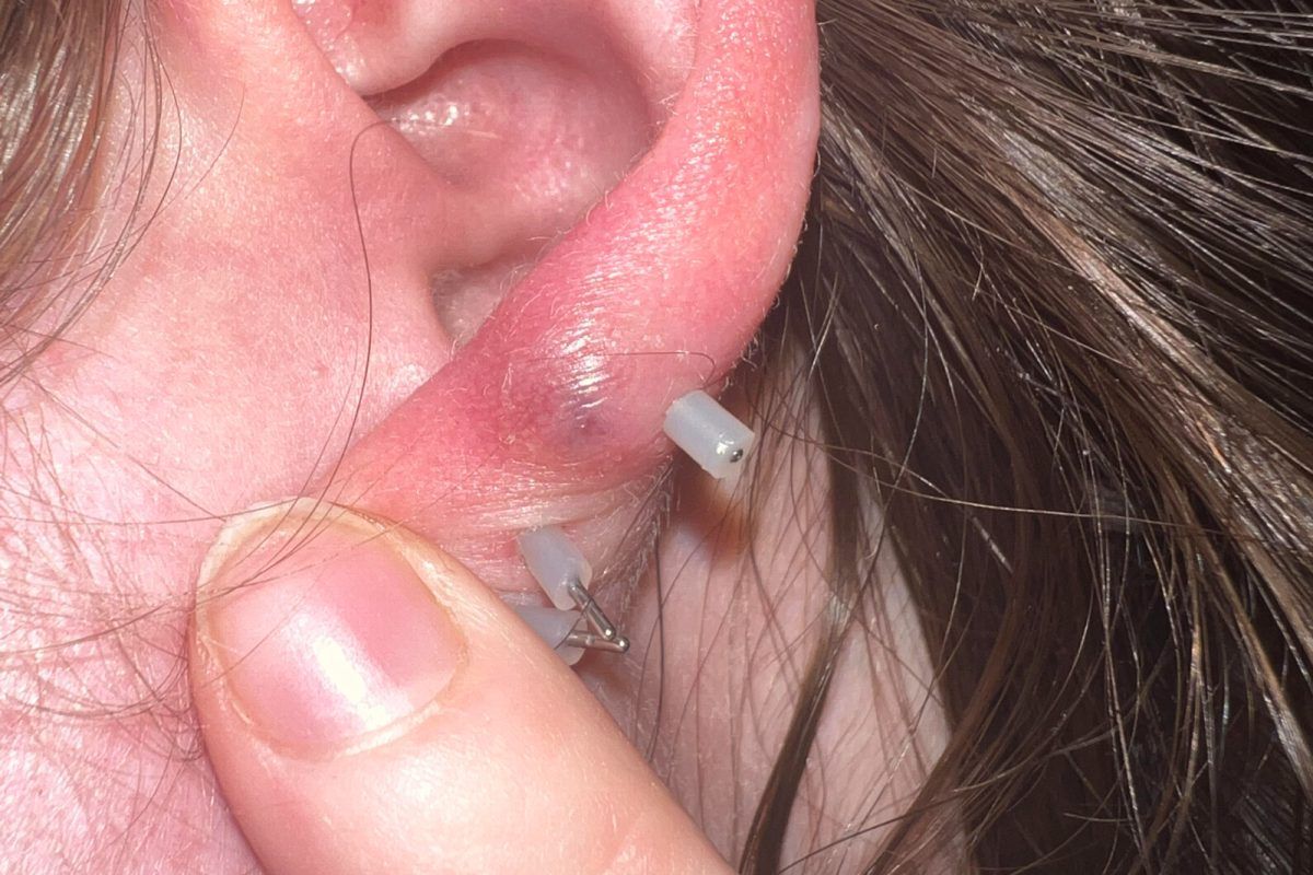 Μόλυνση από σκουλαρίκι: Τα συμπτώματα και πως να την αντιμετωπίσετε 