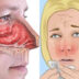 Αλλεργική ρινίτιδα: Τι είναι ποια τα συμπτώματα και ποια η θεραπεία