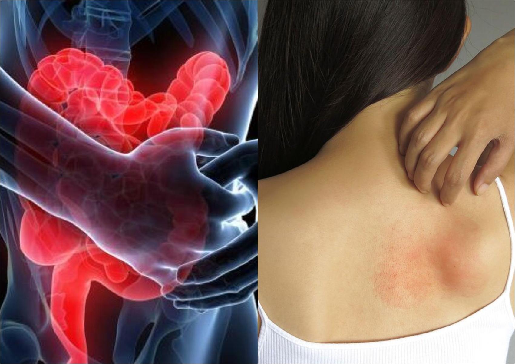 Κοιλιοκάκη: Τι είναι ποια τα συμπτώματα και πως να την αντιμετωπίσετε