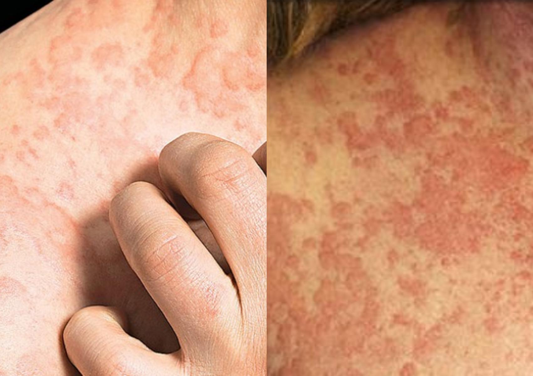 Αναφυλαξία: Τι είναι ποια τα συμπτώματα και πως θα την αντιμετωπίσετε