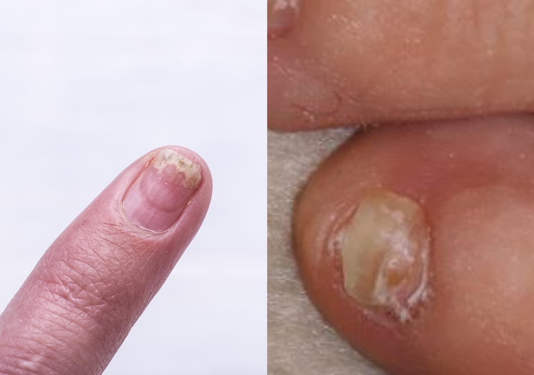 Ονυχόλυση: Τι είναι ποια τα αίτια ποια τα συμπτώματα και ποια η θεραπεία