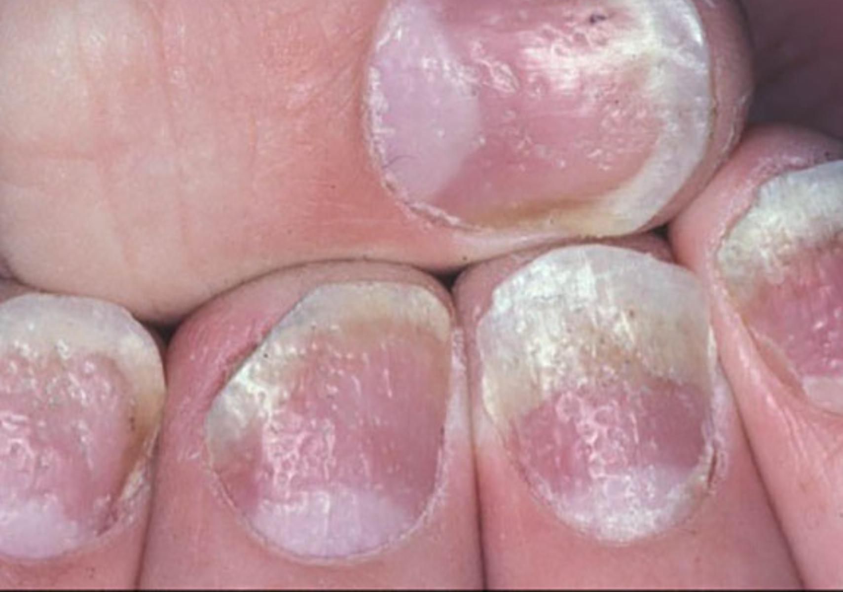 Ονυχόλυση: Τι είναι ποια τα αίτια ποια τα συμπτώματα και ποια η θεραπεία