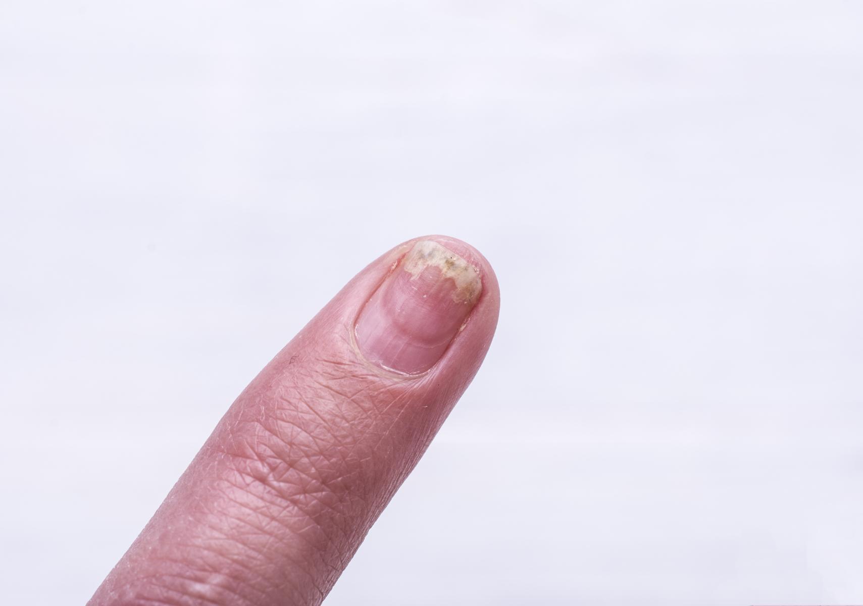 Ονυχόλυση: Τι είναι ποια τα αίτια ποια τα συμπτώματα και ποια η θεραπεία