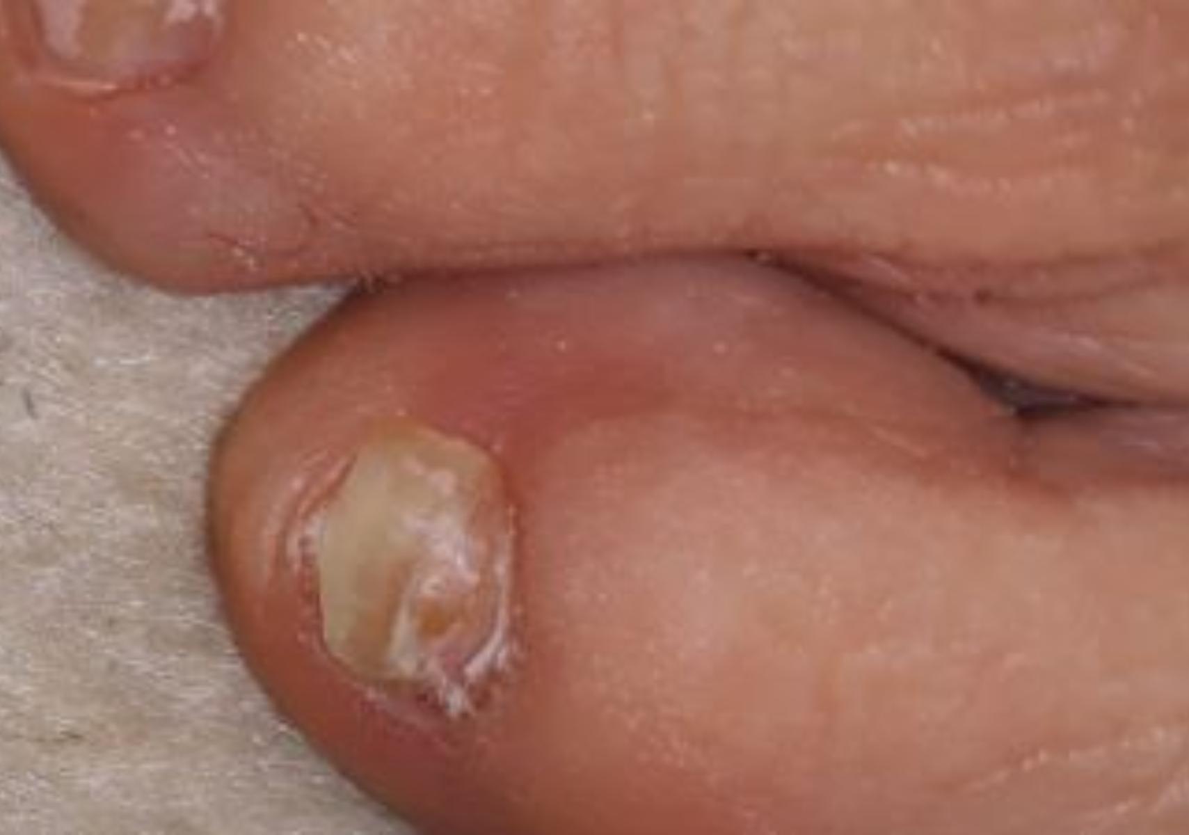 Ονυχόλυση: Τι είναι ποια τα αίτια ποια τα συμπτώματα και ποια η θεραπεία