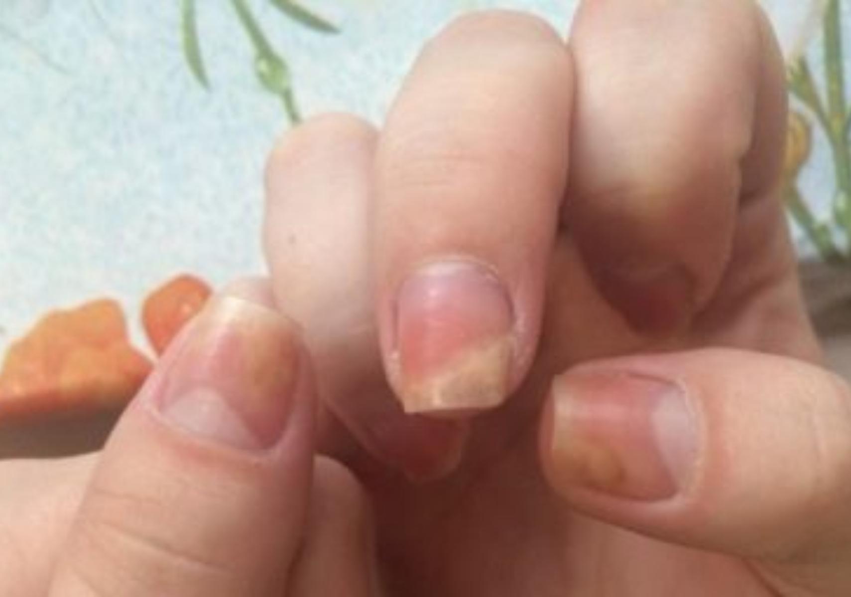 Ονυχόλυση: Τι είναι ποια τα αίτια ποια τα συμπτώματα και ποια η θεραπεία