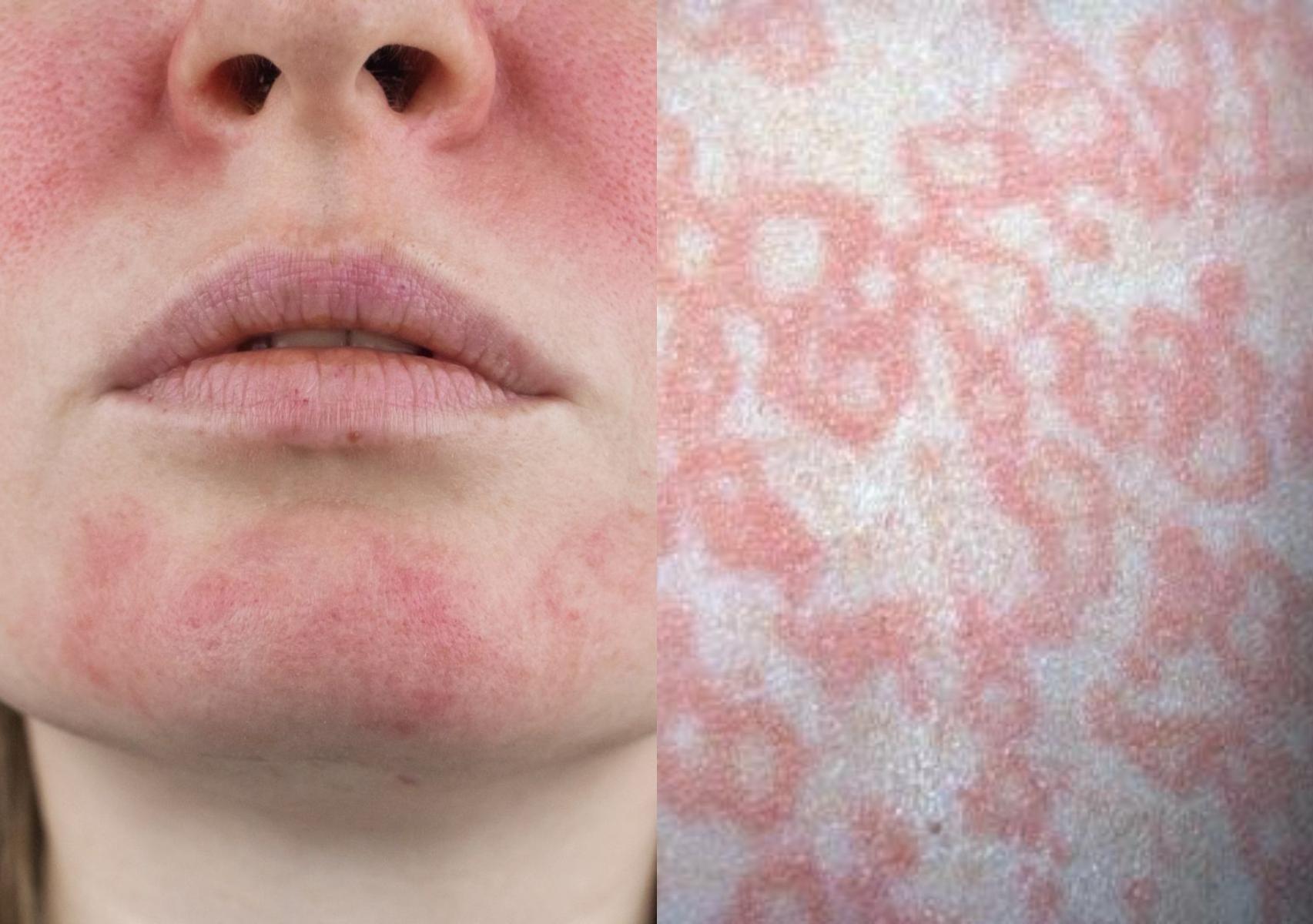 Παρβοϊός ή 5η Νόσος: Τα συμπτώματα στους ενήλικες και οι παρενέργειες