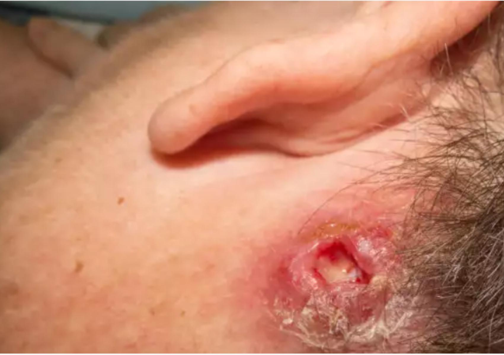 Σταφυλόκοκκος σε έξαρση το καλοκαίρι: Οι επιπλοκές οι κίνδυνοι που κρύβονται στην άμμο και πως να προστατευθούμε