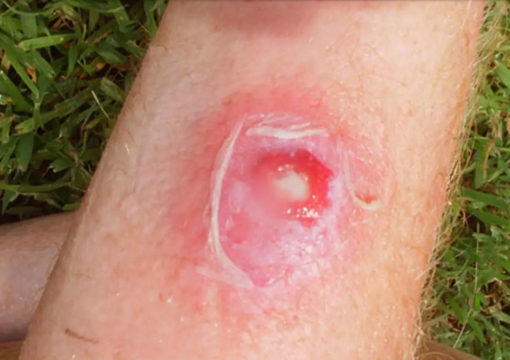 Σταφυλόκοκκος σε έξαρση το καλοκαίρι: Οι επιπλοκές οι κίνδυνοι που κρύβονται στην άμμο και πως να προστατευθούμε